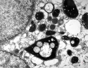 F,14y. | megamitochondria - Wilson disease